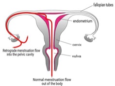 Normal vs. retrograde menses