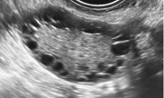 View of a polycystic ovary