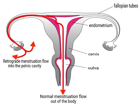 Retrograde Menses