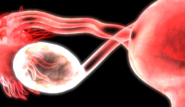 Ovarian Cancer