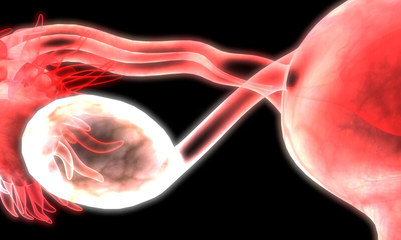 Ovarian Cancer