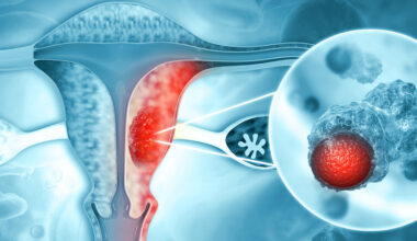 Uterine Cancer