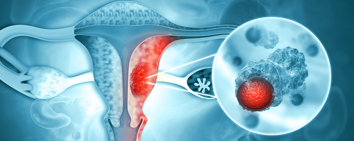 Uterine Cancer