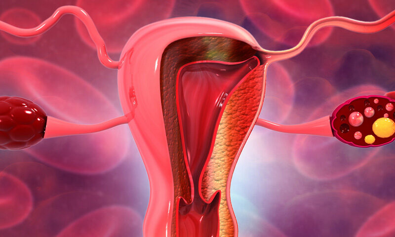 Endometriosis
