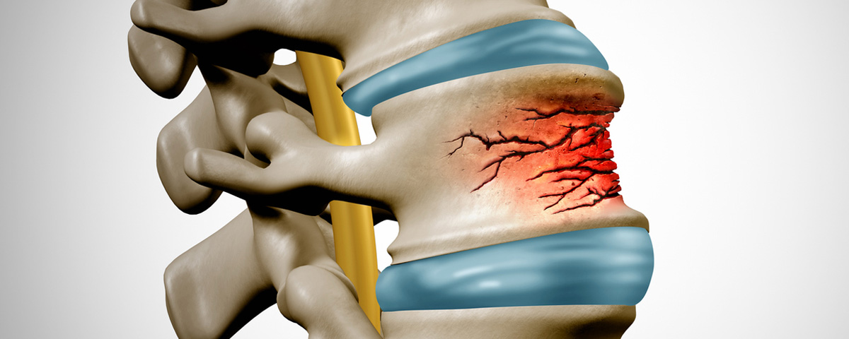 Osteoporosis