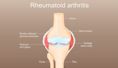 Arthritis