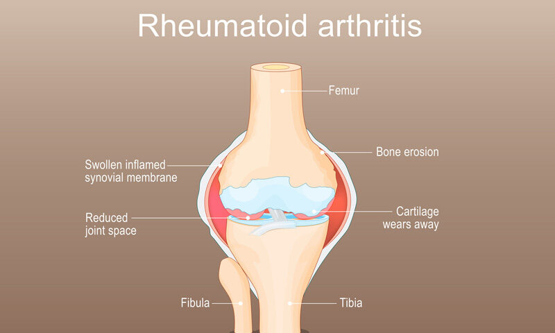 Arthritis