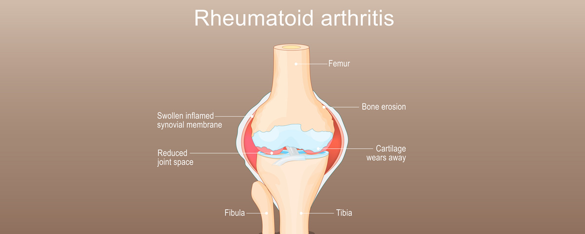 Arthritis