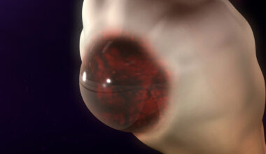 Endometrioma