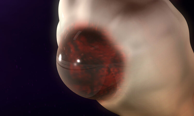 Endometrioma