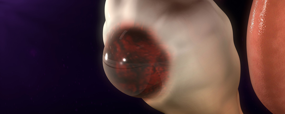 Endometrioma