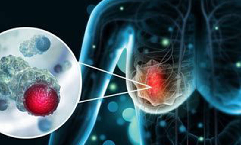 Triple Negative Breast Cancer