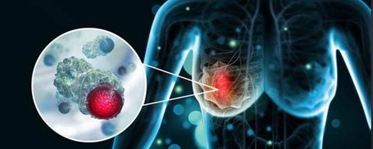 Triple Negative Breast Cancer