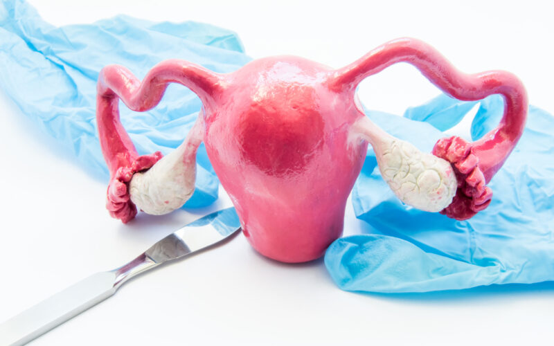 Hysterectomy