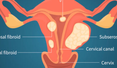 Fibroids