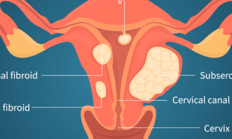 Fibroids