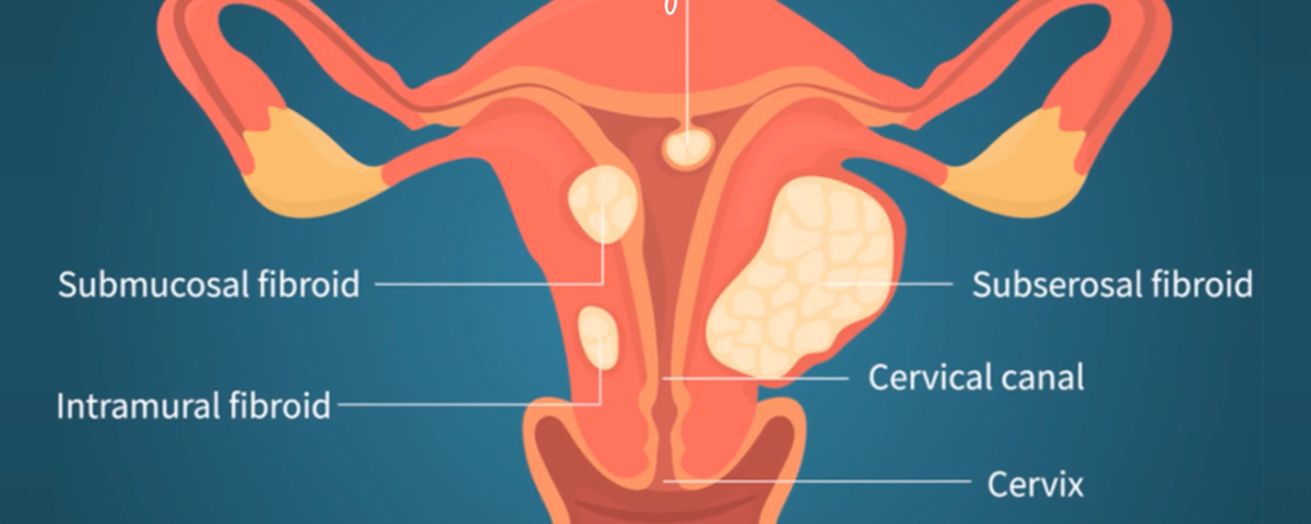 Fibroids