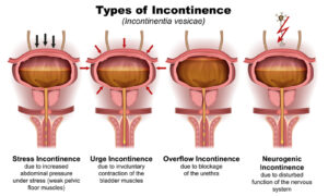 Urinary Incontinence in Women