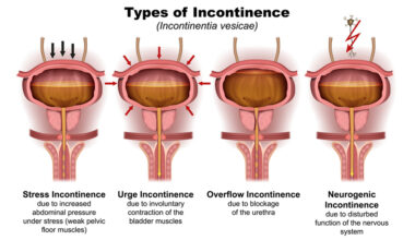 Urinary Incontinence in Women