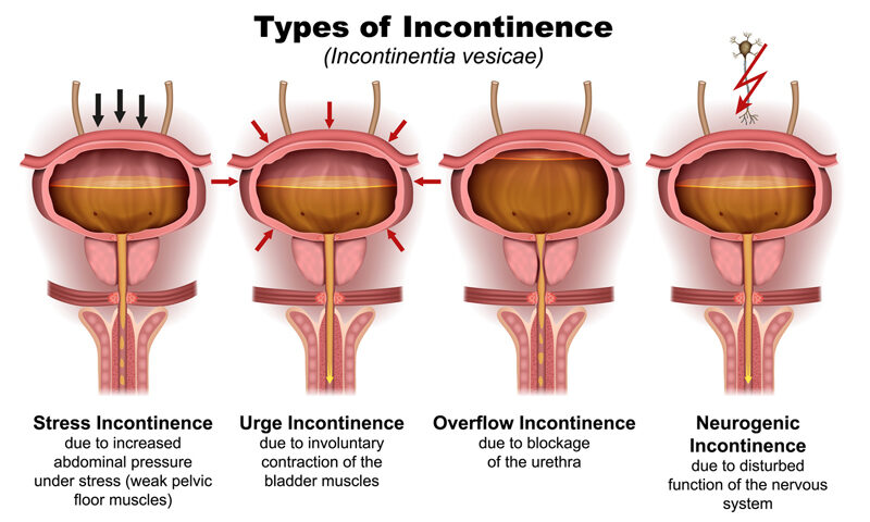 Urinary Incontinence in Women
