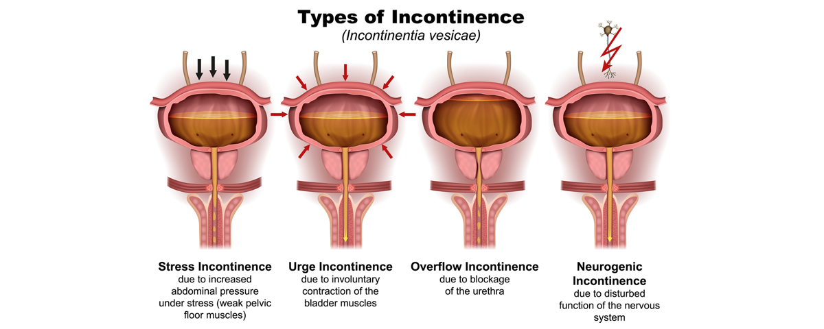 Urinary Incontinence in Women